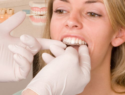 Trattamento Invisalign: cos’è e come funziona