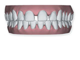 Denti con spaziatura eccessiva