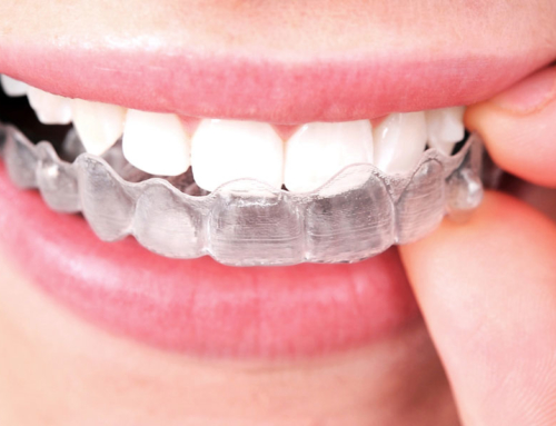Invisalign: idoneità al trattamento