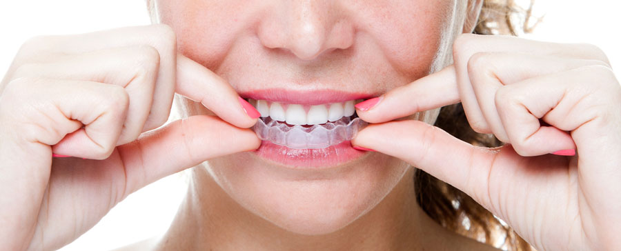 Trattamento Invisalign