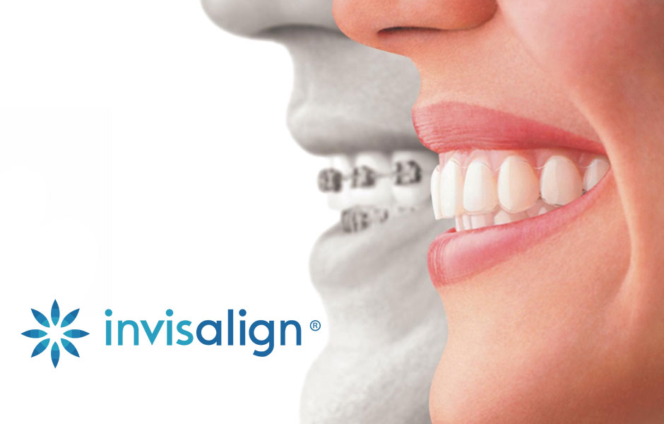 Invisalign | Studio Cantagalli