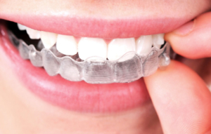 Invisalign