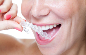 Invisalign